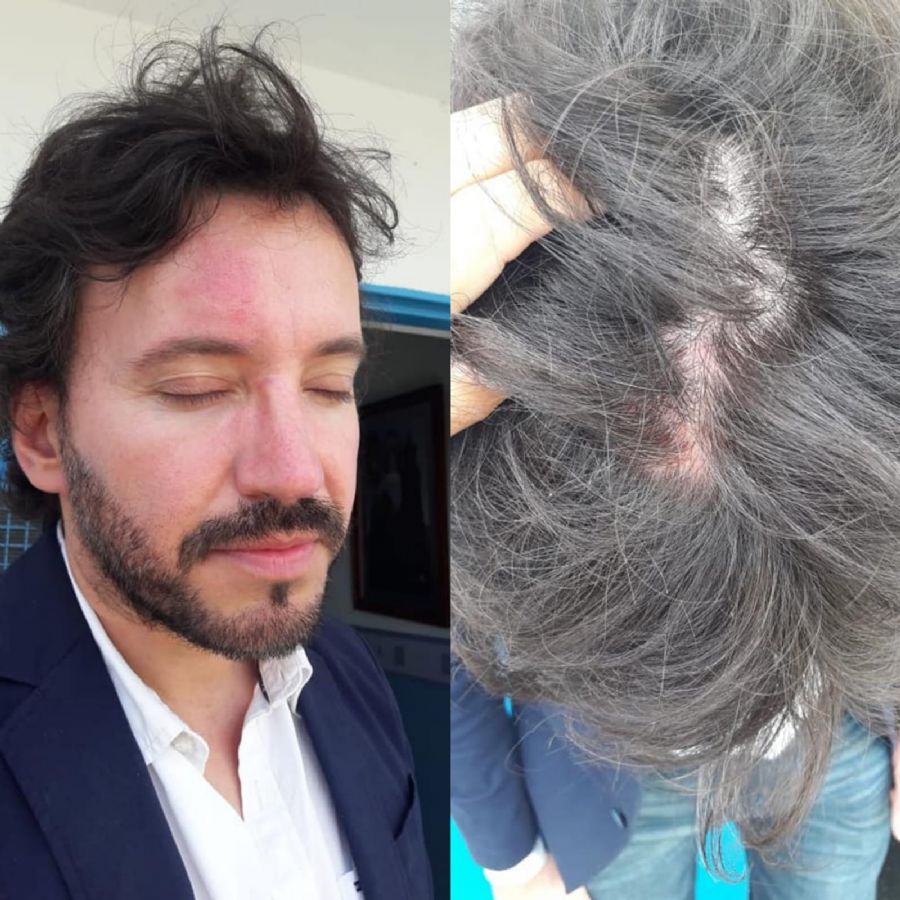 Del Frari mostrando las "secuelas" de su pelea con su entonces par en el Concejo Deliberante de Salta, Alberto Castillo.